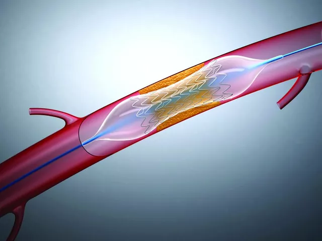 Angioplasty and Stenting: Treatment Options for Coronary Artery Disease